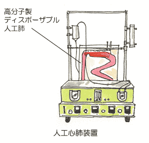 高分子製ディスポーザブル人工肺