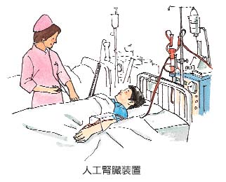 人工腎臓装置