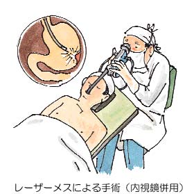 レーザーメスによる手術(内視鏡併用)